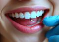 How Long Does Composite Bonding Last? Tips for a Lasting Smile